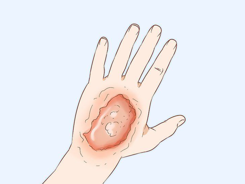زخم بعد از رادیوتراپی