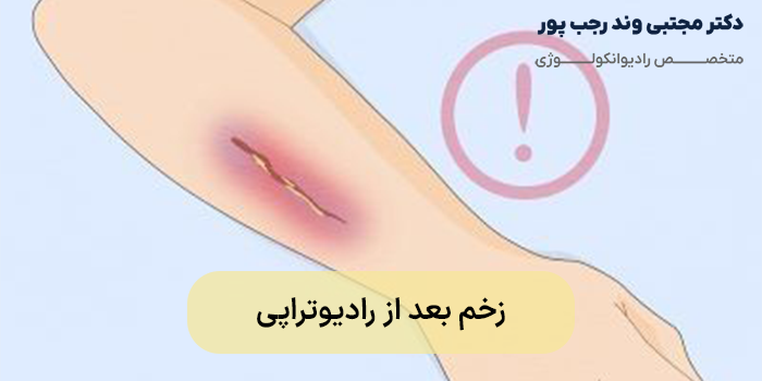 زخم بعد از رادیوتراپی