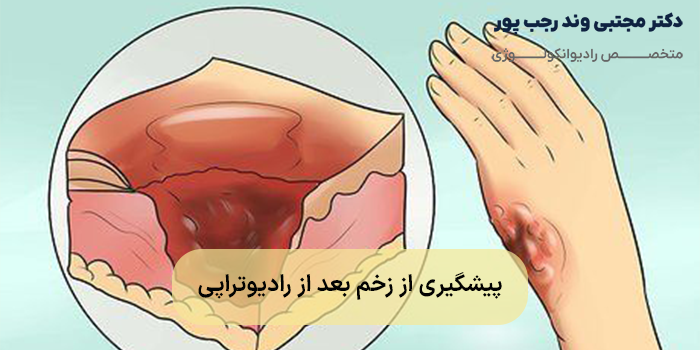 پیشگیری از زخم بعد از رادیوتراپی