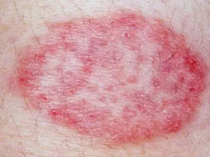 درمان سرطان پوست