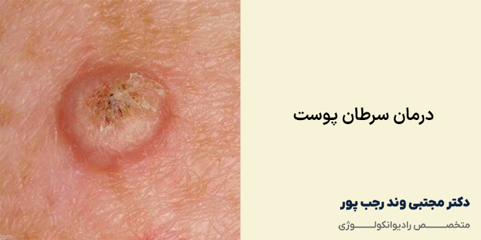 درمان سرطان پوست