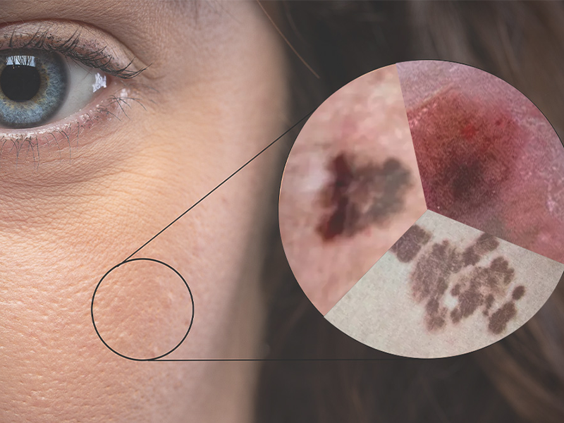 انواع سرطان پوست