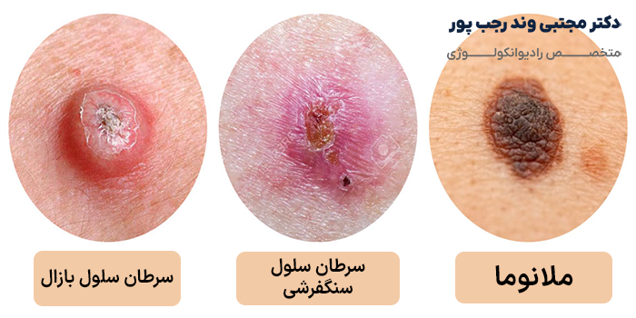 انواع سرطان پوست