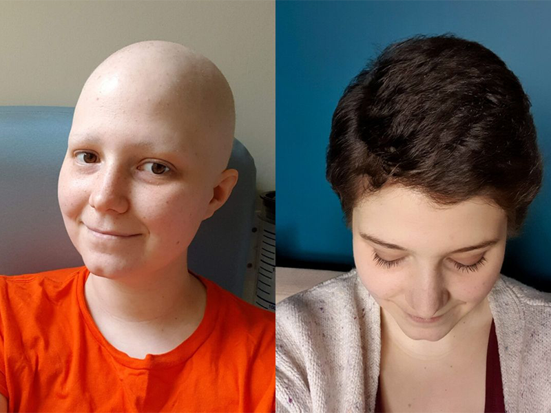 رشد مو بعد از شیمی درمانی