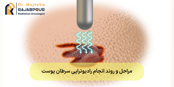 مراحل و روند انجام رادیوتراپی سرطان پوست